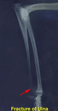 fracture-ulna